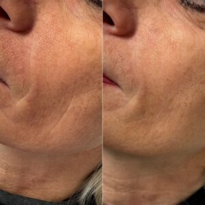 sculptra biosphera med brescia acido polilattico