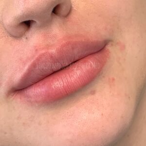 Filler Labbra Brescia - prima e dopo (3)