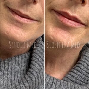 Filler Labbra Brescia - prima e dopo (4)