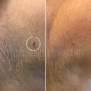 Soft surgery - prima e dopo (3)