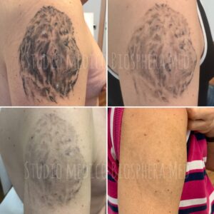 Epilazione tatuaggi brescia - prima e dopo (2)