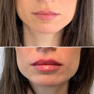 Filler Labbra Brescia - prima e dopo (5)